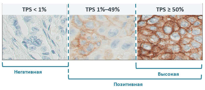 Экспрессия PD-L1 на опухолевых клетках